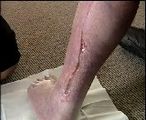 How honey heals wounds